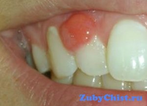 А Вы знаете, какие антибиотики принимать при флюсе?