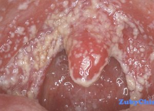 А Вы знаете что такое кандидозный стоматит