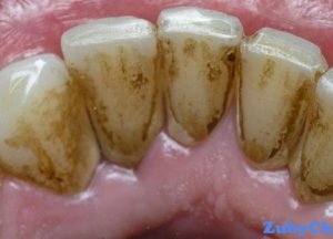 Налет на зубах&nbsp;&mdash; как можно устранить самостоятельно?