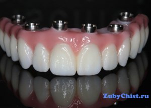 Вы еще не знаете про зубные протезы: секреты прекрасной улыбки