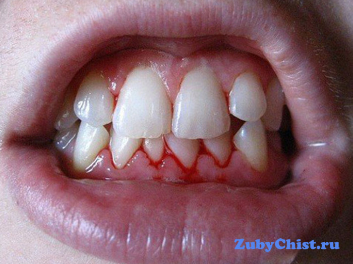 Кровоточивость десен