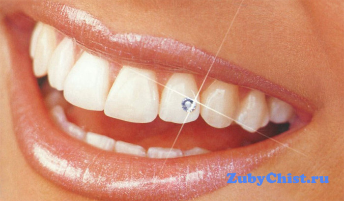 стразы на зубах