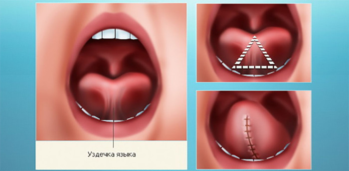 Френулотомия уздечки языка