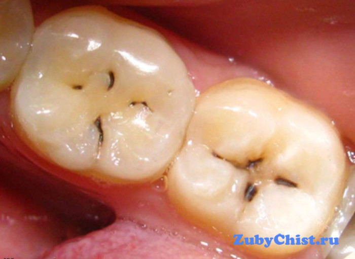 Поверхностный кариес зуба