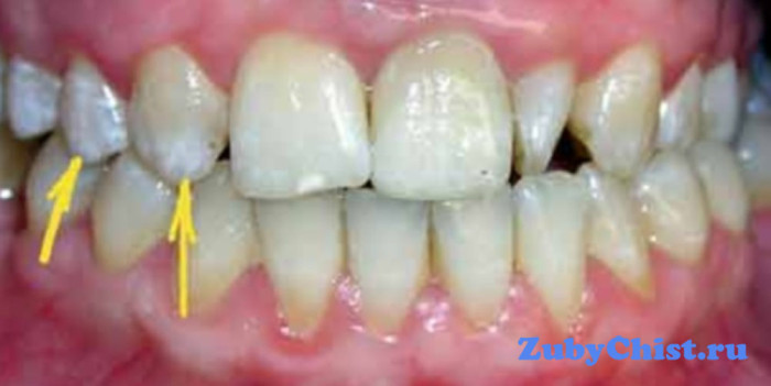 Потемнение эмали зуба