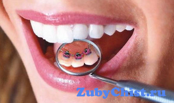 Установка брекетов