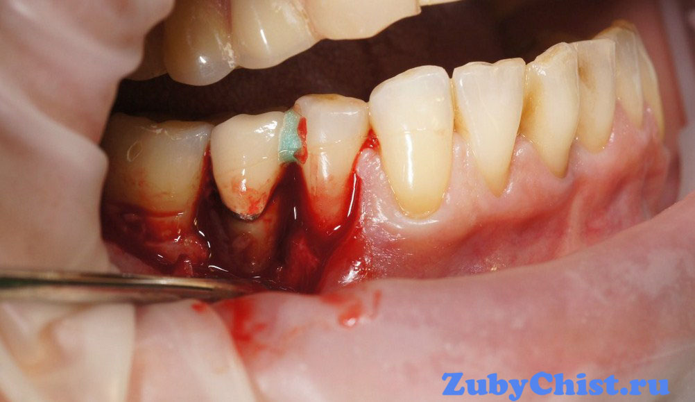 Открытый кюретаж