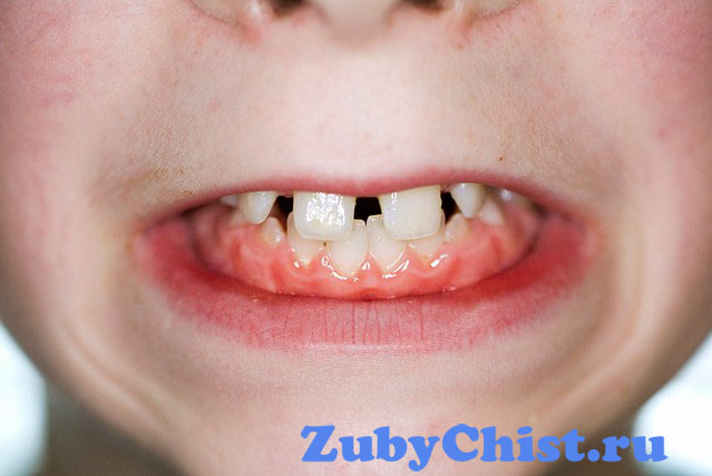 Зубы у болеющих бруксизмом