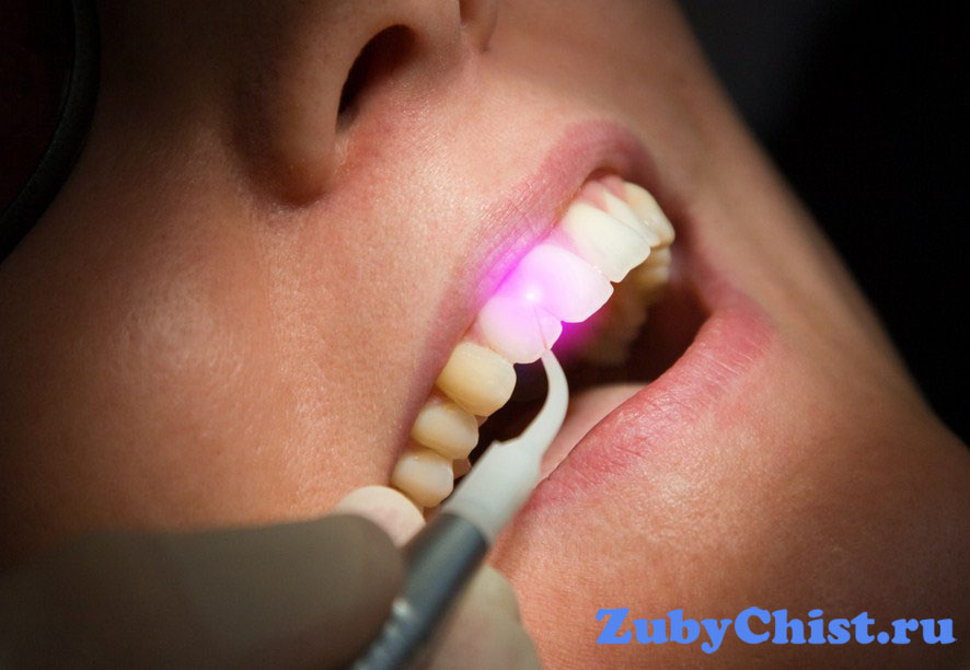 Лечение зубов лазером