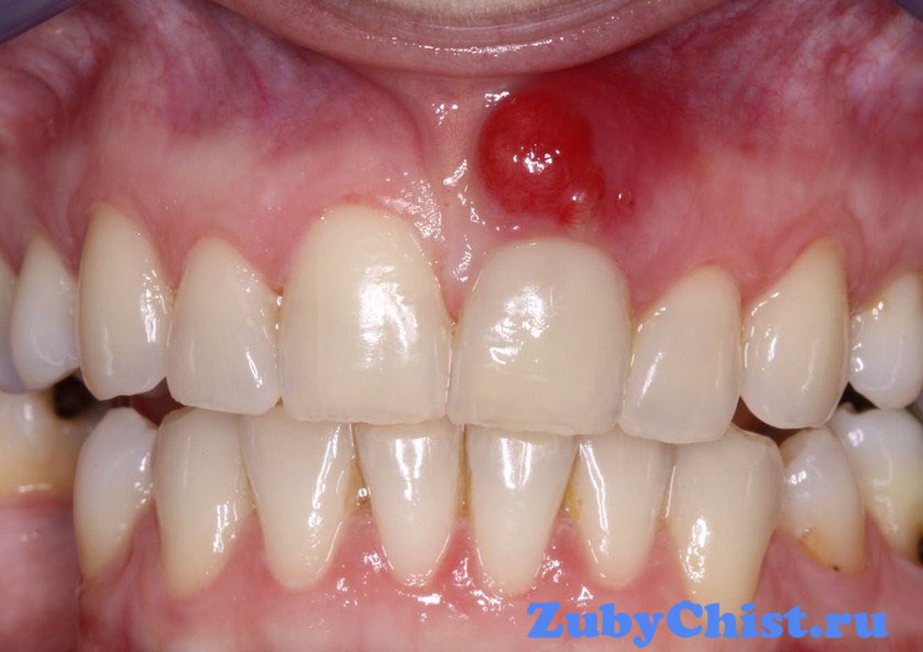 Флюс на десне