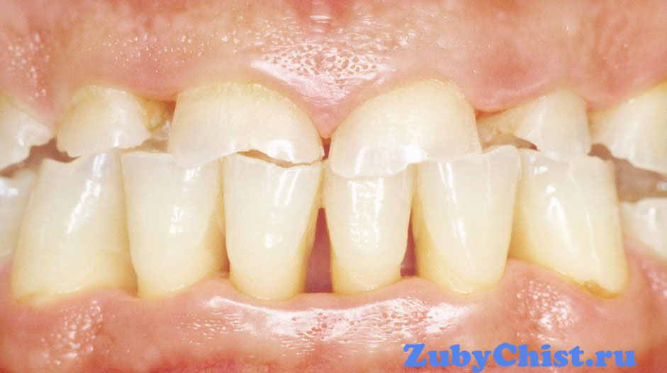Неправильный прикус у взрослых при бруксизме