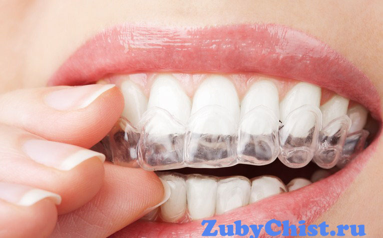 Окклюзионная каппа при бруксизме