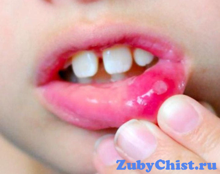 Стоматит у маленьких детей