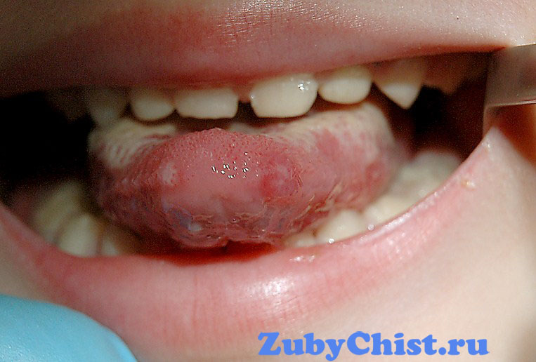 Герпетический стоматит у детей