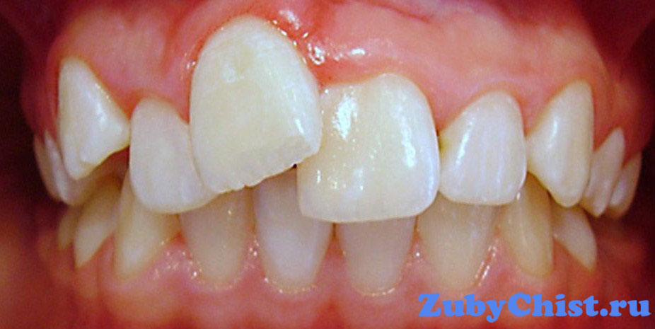 Паталогический прикус