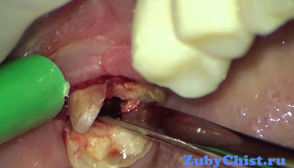 Удаление зуба