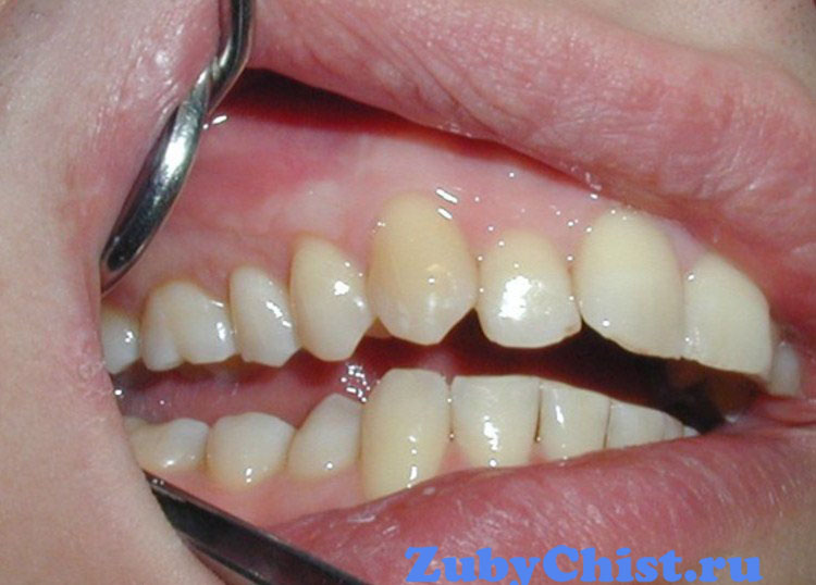 Лечение свища у стоматолога