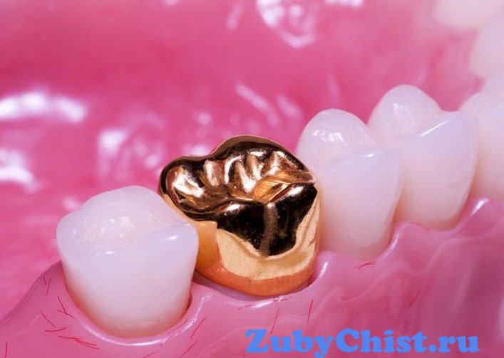 Коронки на передние зубы