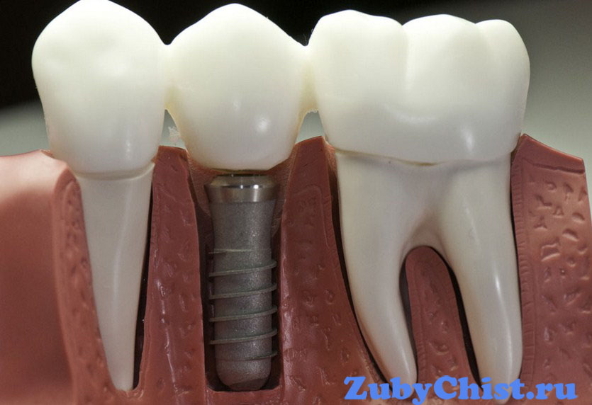 Установленная коронка