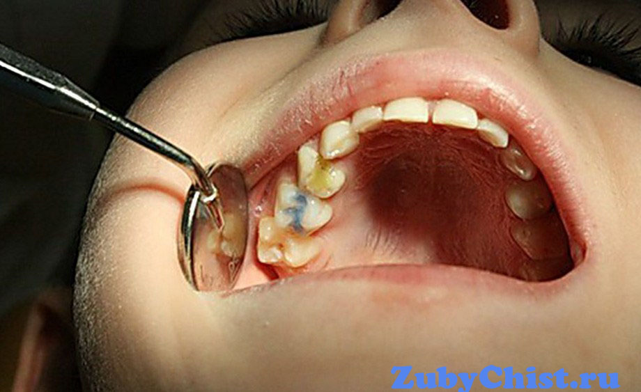 Хронический периостит