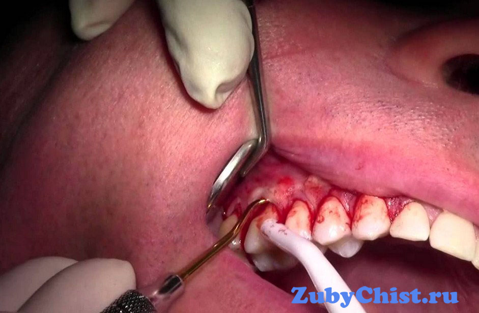 Закрытый кюретаж в стоматологической клинике