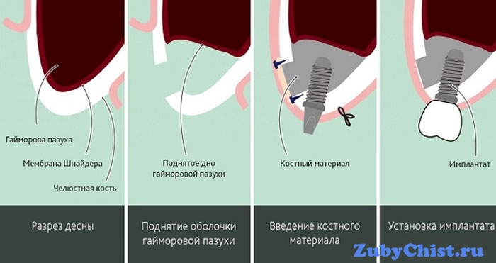 Этапы проведения процедуры