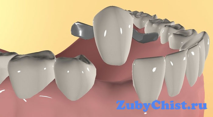Адгезивные мосты