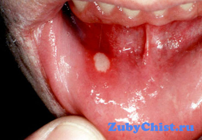 Лечение афтозного стоматита