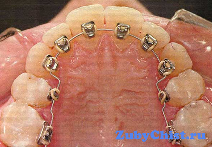 Безлигатурные брекеты