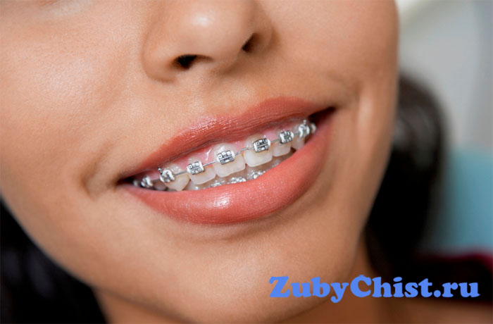 Брекеты для выравнивания зубов