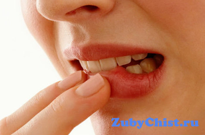 Сильно воспалилась десна