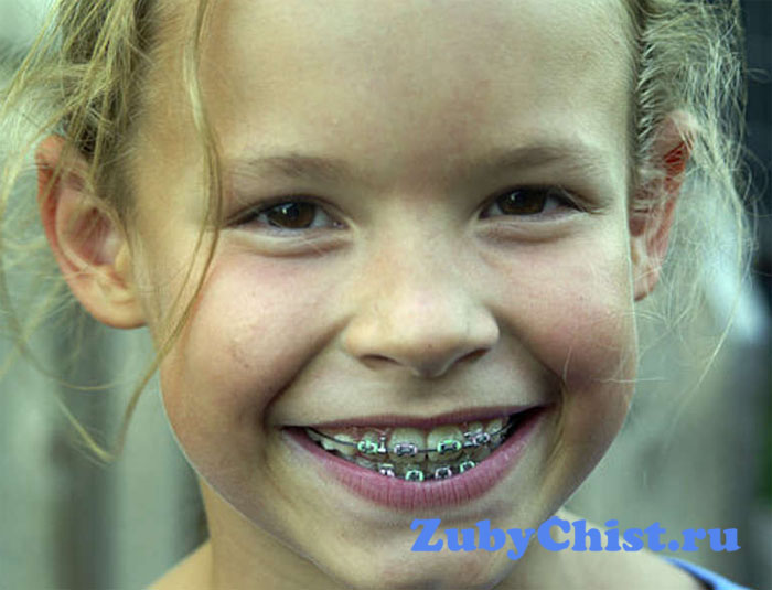 Выравнивание зубов у детей