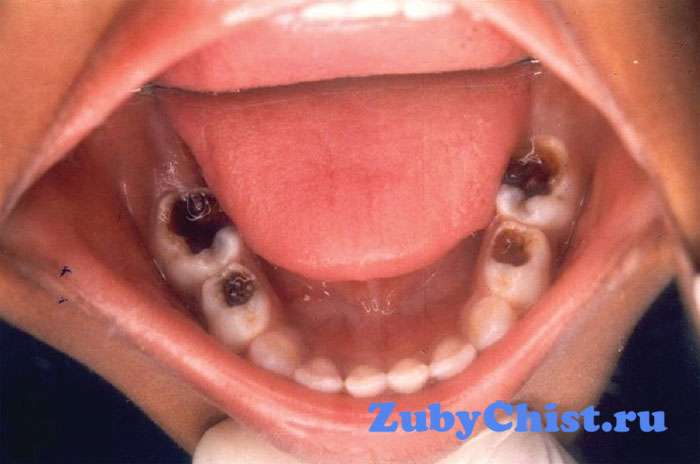 Гангренозный пульпит