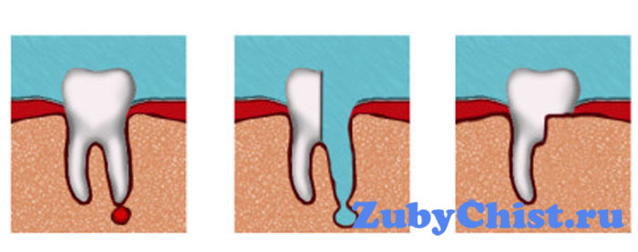 Гемисекция зуба