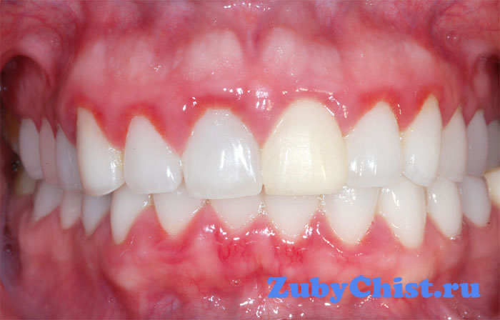 Гингивит десен