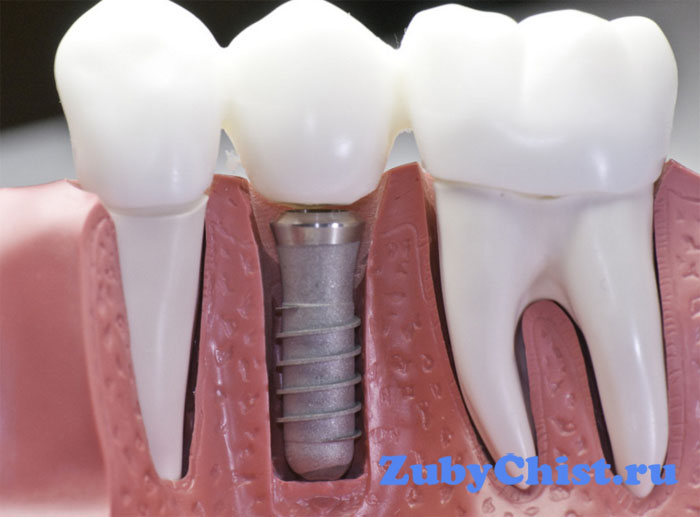 Запрещена имплантация зубов