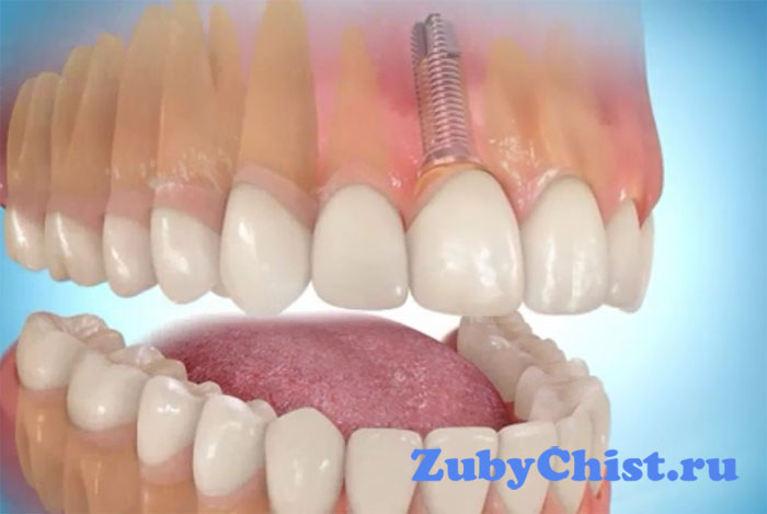 Имплантация зубов в стоматологии