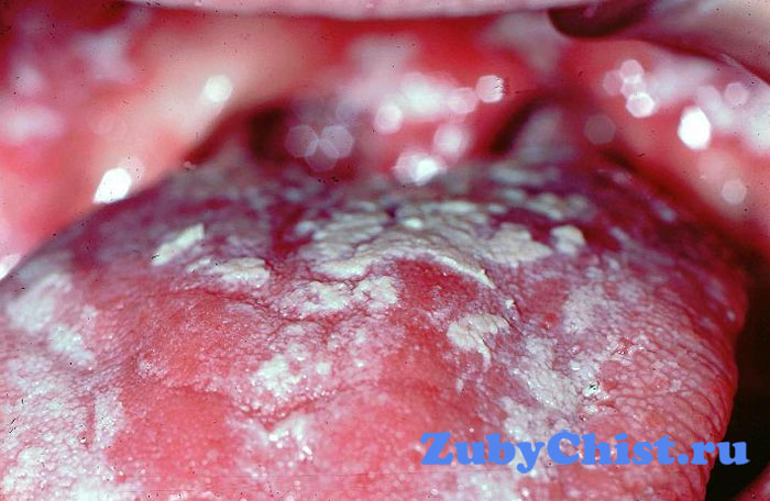 Кандидозный стоматит ребенка