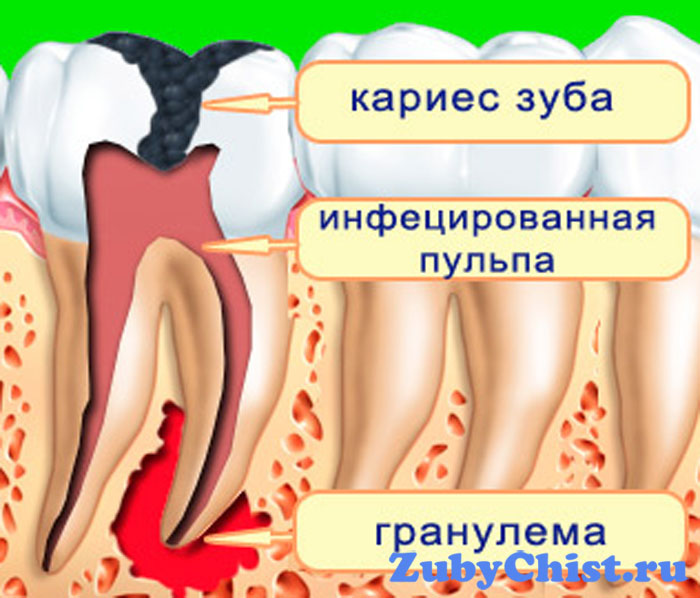 Кариозный очаг в зубе