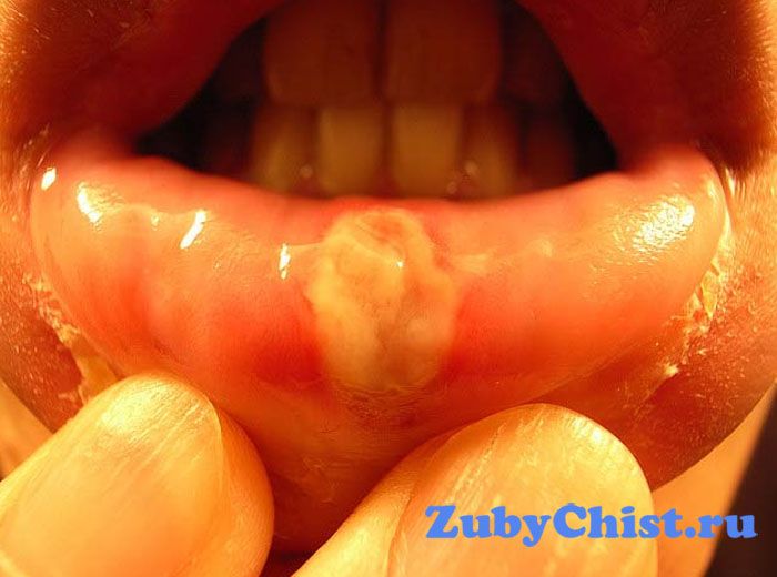 Катаральный стоматит