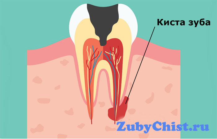 Киста зуба