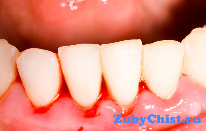 Кровоточивость десен у взрослых