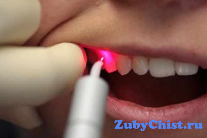 Лазерная чистка зубов
