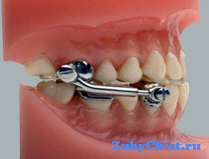 Лечение аппаратом Гербста