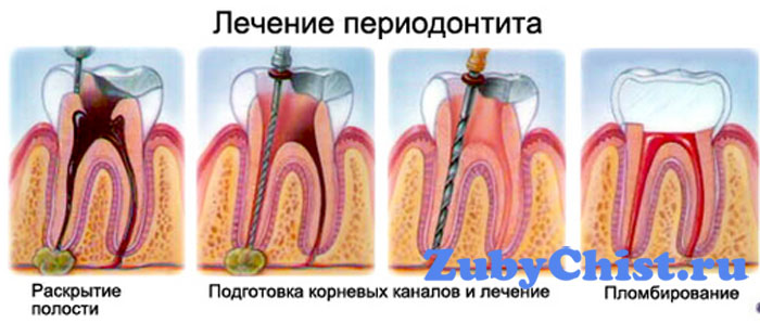 Лечение периодонтита