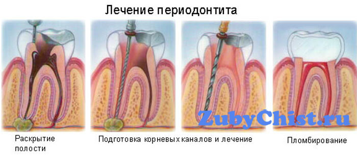 Лечение периодонтита
