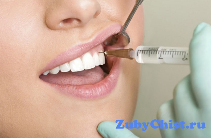 Местная анестезия в стоматологии