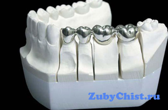 Металлический зубной мост