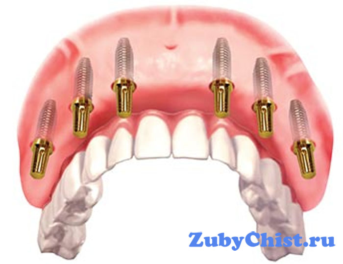 Мостовидная конструкция имплантов