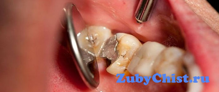 Мышьяк в стоматологии